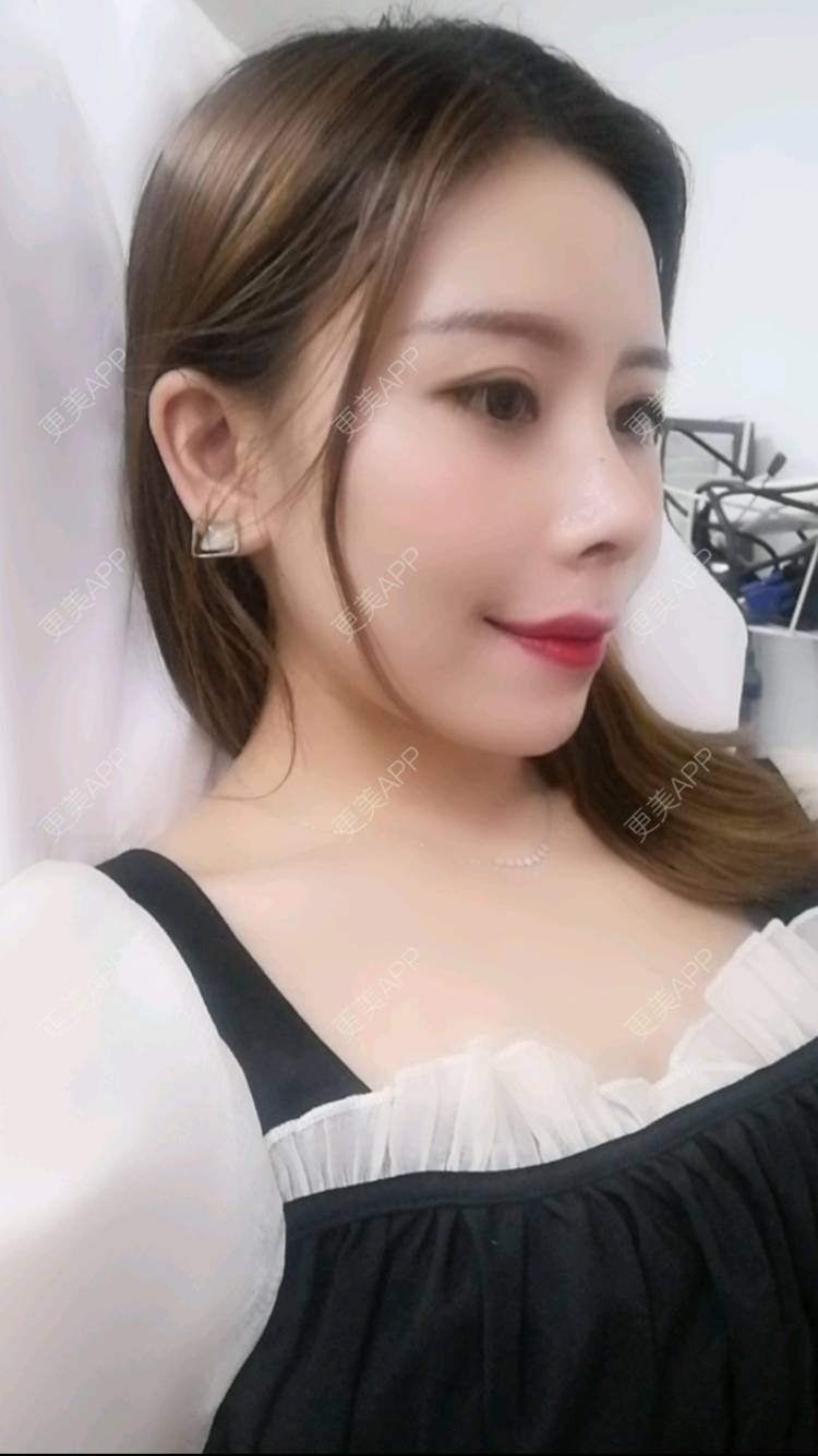 瓷娃娃娃呀的自体软骨垫鼻尖日记