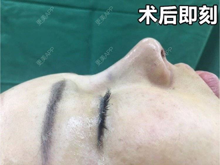 更美 - 深圳鹏爱医疗美容医院的鼻部多项经验 | 鼻部多项 | 深圳