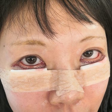 外切去眼袋前后对比图_yuan来如此~整形分享_更美