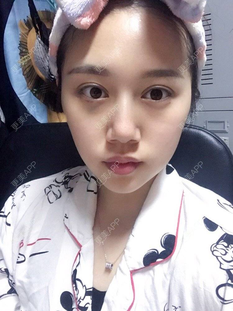 更美 - 更美用户UQwEIxXDhd的射频提升经验 | 射频提升