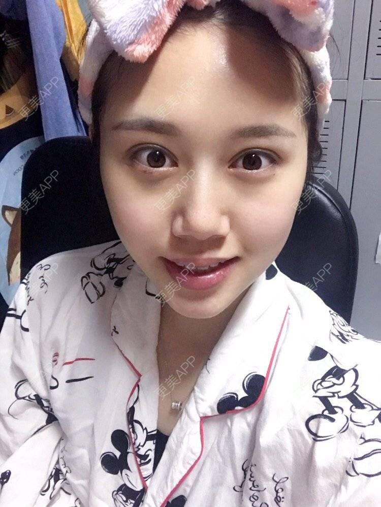 更美 - 更美用户UQwEIxXDhd的射频提升经验 | 射频提升