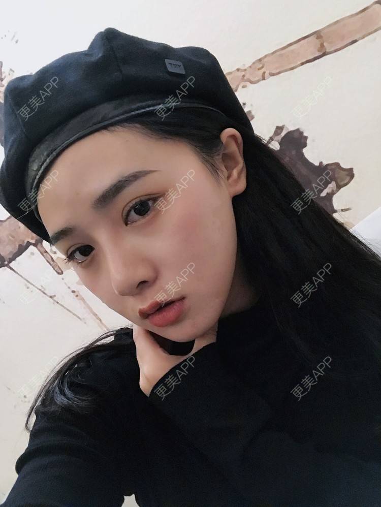 更美 - 更美用户AW5ZRyRynC的除皱瘦脸经验 | Fotona4D | 除皱瘦脸 | 西安 | 射频提升