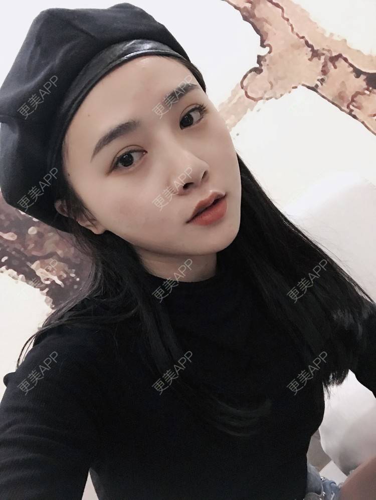 更美 - 更美用户AW5ZRyRynC的除皱瘦脸经验 | Fotona4D | 除皱瘦脸 | 西安 | 射频提升