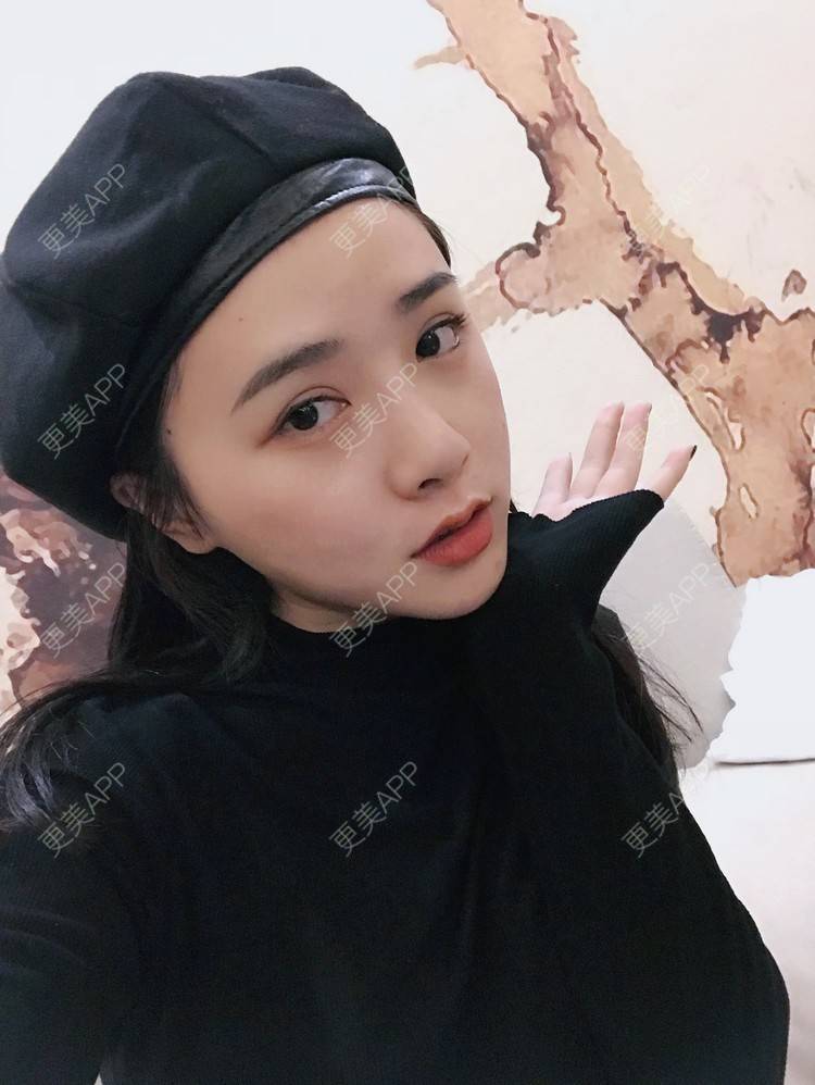 更美 - 更美用户AW5ZRyRynC的除皱瘦脸经验 | Fotona4D | 除皱瘦脸 | 西安 | 射频提升