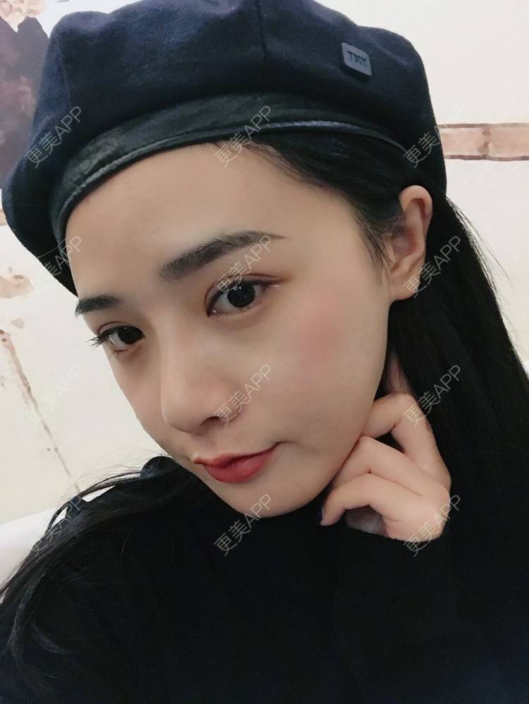 更美 - 更美用户AW5ZRyRynC的除皱瘦脸经验 | Fotona4D | 除皱瘦脸 | 西安 | 射频提升