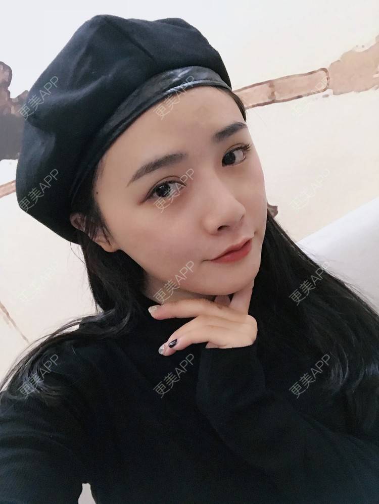 更美 - 更美用户AW5ZRyRynC的除皱瘦脸经验 | Fotona4D | 除皱瘦脸 | 西安 | 射频提升