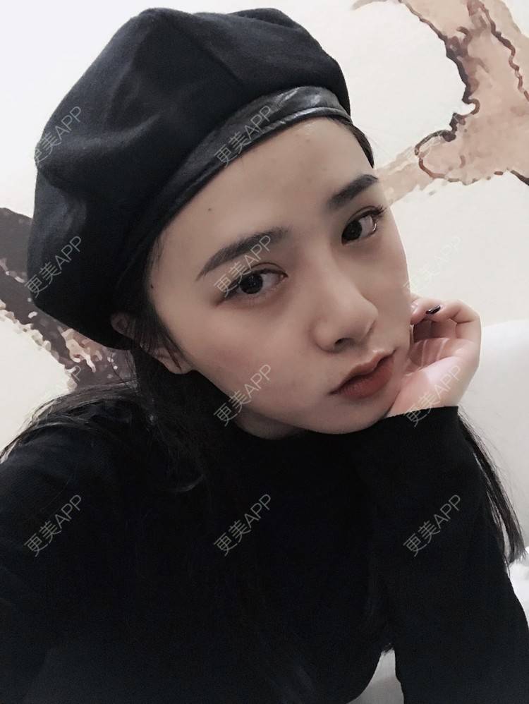 更美 - 更美用户AW5ZRyRynC的除皱瘦脸经验 | Fotona4D | 除皱瘦脸 | 西安 | 射频提升