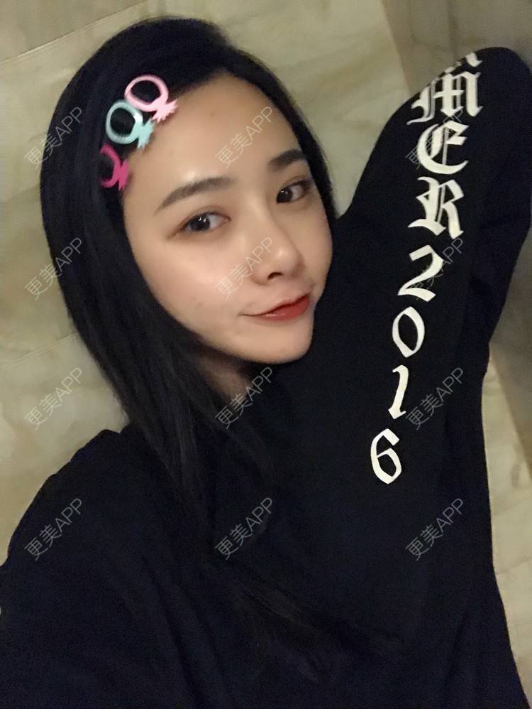 更美 - 更美用户AW5ZRyRynC的除皱瘦脸经验 | 除皱瘦脸 | 西安 | 射频提升 | Fotona4D