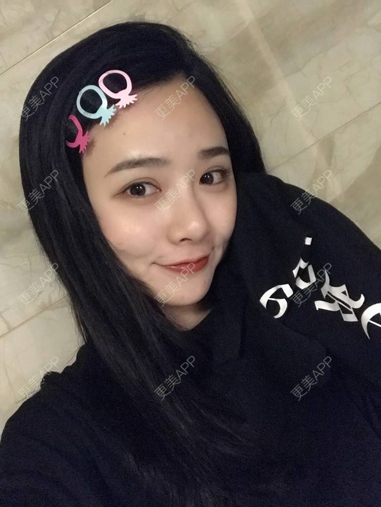 更美 - 更美用户AW5ZRyRynC的除皱瘦脸经验 | 除皱瘦脸 | 西安 | 射频提升 | Fotona4D
