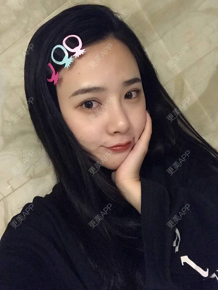 更美 - 更美用户AW5ZRyRynC的除皱瘦脸经验 | 除皱瘦脸 | 西安 | 射频提升 | Fotona4D