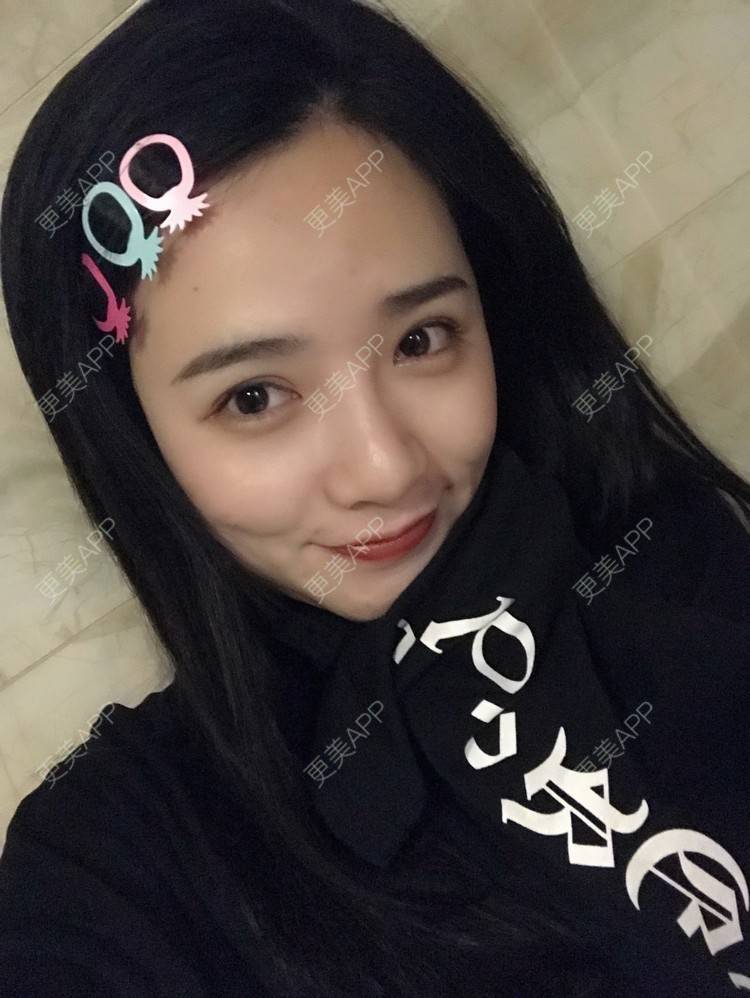 更美 - 更美用户AW5ZRyRynC的除皱瘦脸经验 | 除皱瘦脸 | 西安 | 射频提升 | Fotona4D