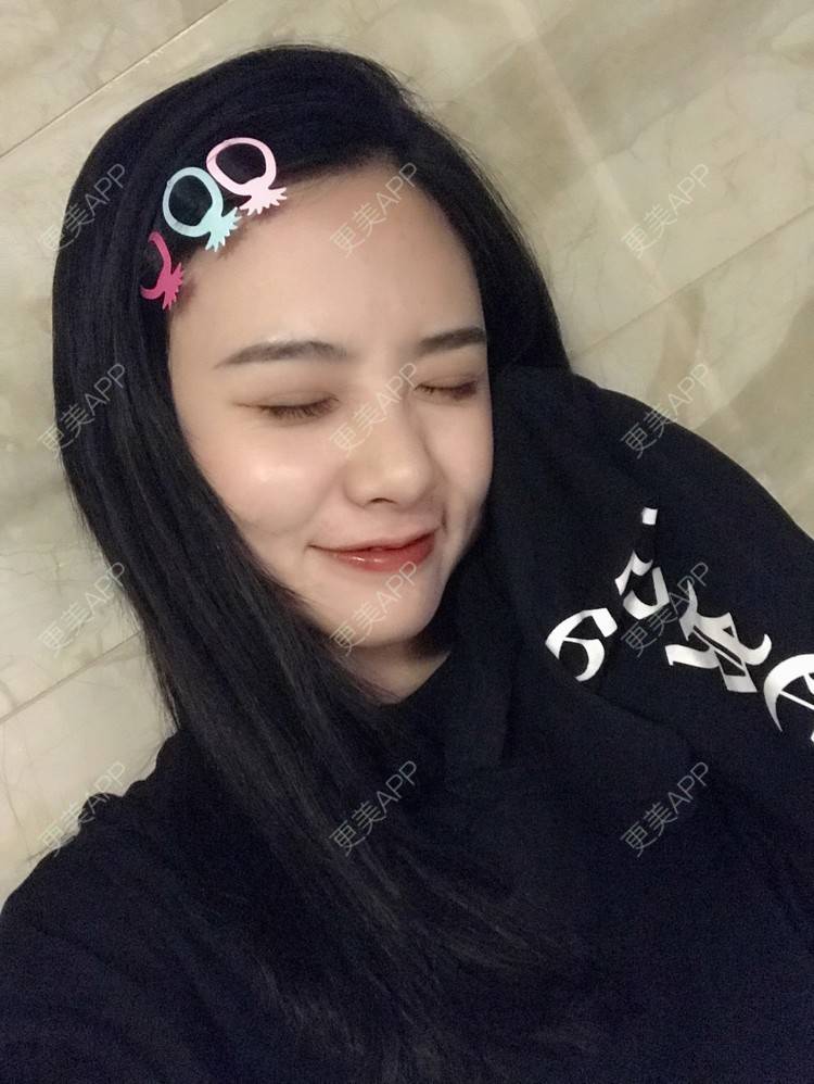 更美 - 更美用户AW5ZRyRynC的除皱瘦脸经验 | 除皱瘦脸 | 西安 | 射频提升 | Fotona4D