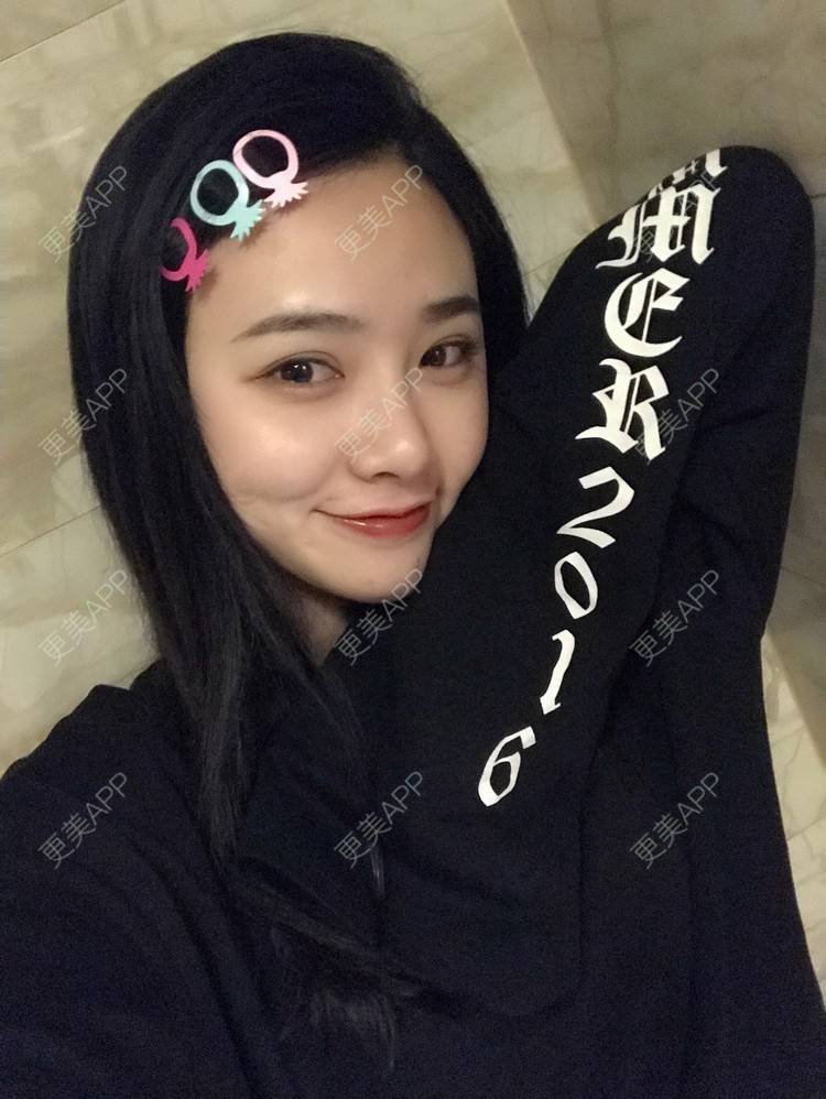 更美 - 更美用户AW5ZRyRynC的除皱瘦脸经验 | 除皱瘦脸 | 西安 | 射频提升 | Fotona4D