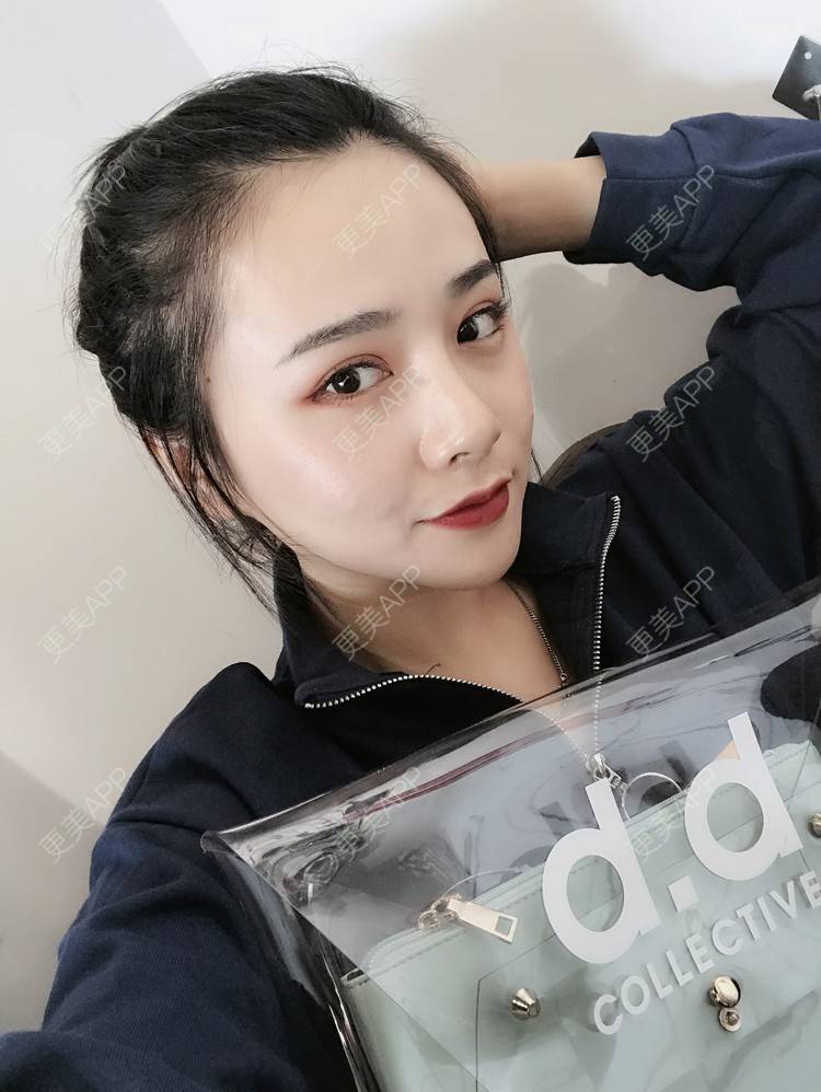 更美 - 更美用户AW5ZRyRynC的除皱瘦脸经验 | 除皱瘦脸 | 西安 | 射频提升 | Fotona4D