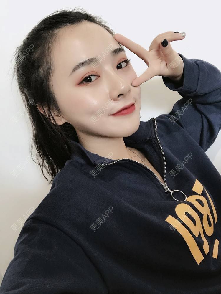更美 - 更美用户AW5ZRyRynC的除皱瘦脸经验 | 除皱瘦脸 | 西安 | 射频提升 | Fotona4D