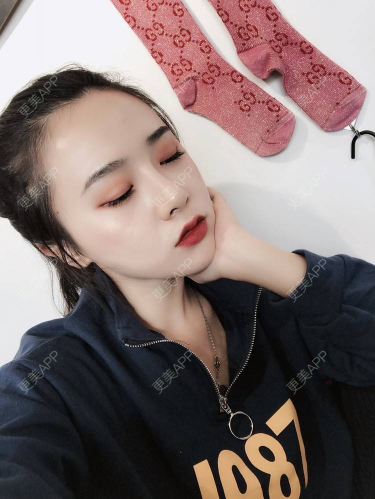 更美 - 更美用户AW5ZRyRynC的除皱瘦脸经验 | 除皱瘦脸 | 西安 | 射频提升 | Fotona4D