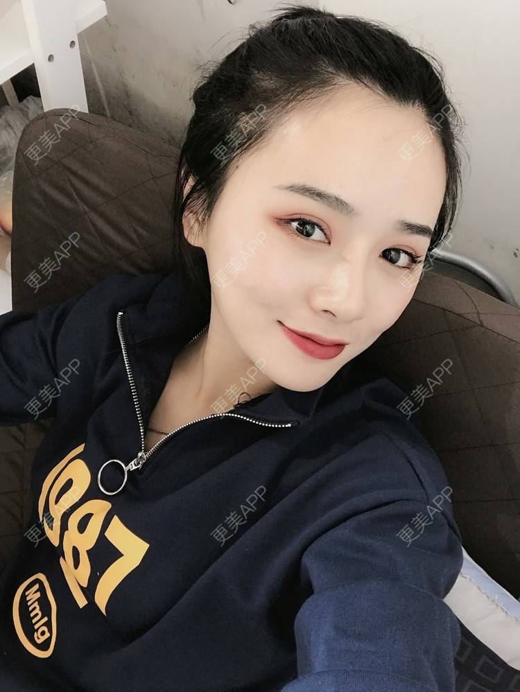 更美 - 更美用户AW5ZRyRynC的除皱瘦脸经验 | 除皱瘦脸 | 西安 | 射频提升 | Fotona4D