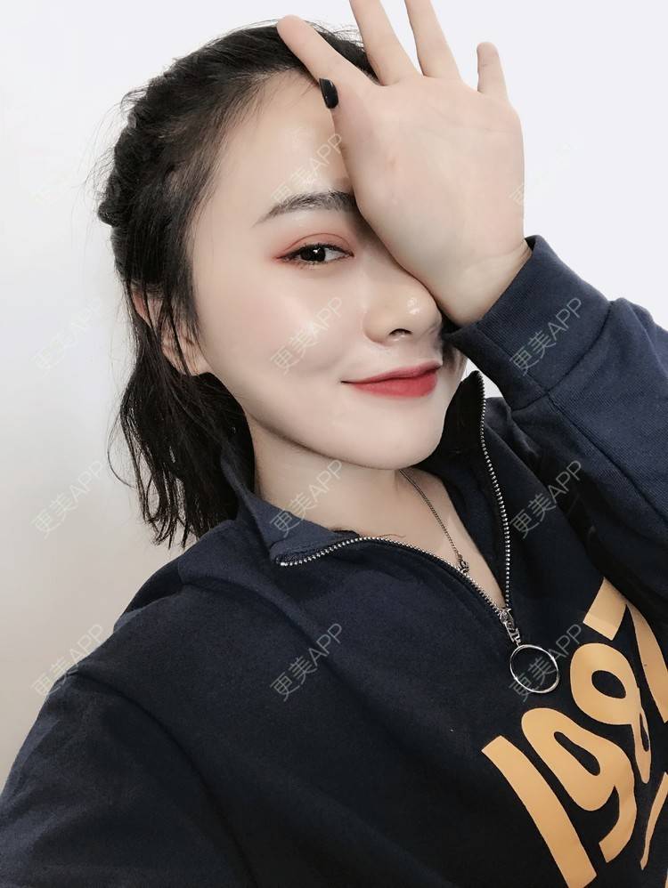 更美 - 更美用户AW5ZRyRynC的除皱瘦脸经验 | 除皱瘦脸 | 西安 | 射频提升 | Fotona4D