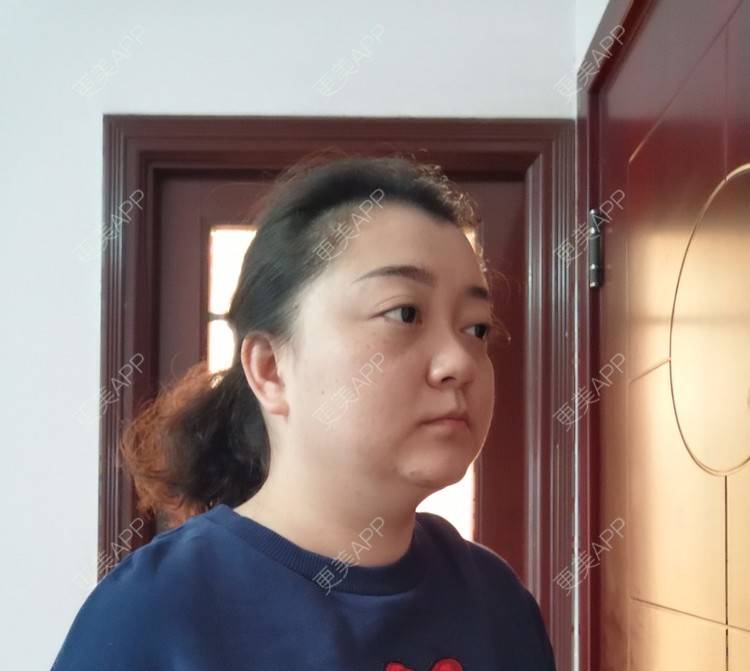 更美 - 更美用户ID74FSnd7S的颈部经验 | 热玛吉 | 颈部 | 除皱 | 重庆 | 超声提升 | 埋线除皱 | 射频提升 | 热拉提 | 肤质检测 | 皮肤综合管理套餐 | 除皱套餐