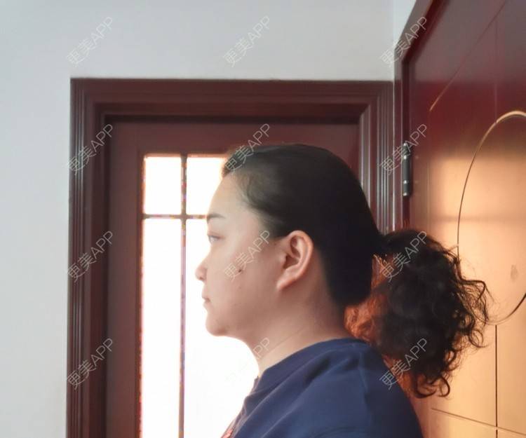 更美 - 更美用户ID74FSnd7S的颈部经验 | 热玛吉 | 颈部 | 除皱 | 重庆 | 超声提升 | 埋线除皱 | 射频提升 | 热拉提 | 肤质检测 | 皮肤综合管理套餐 | 除皱套餐