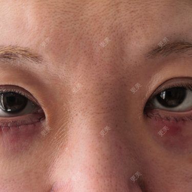 yuan来如此的外切祛眼袋日记