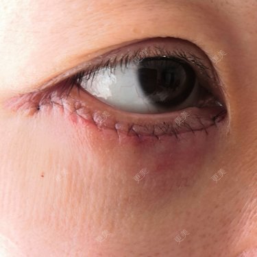 yuan来如此的外切祛眼袋日记