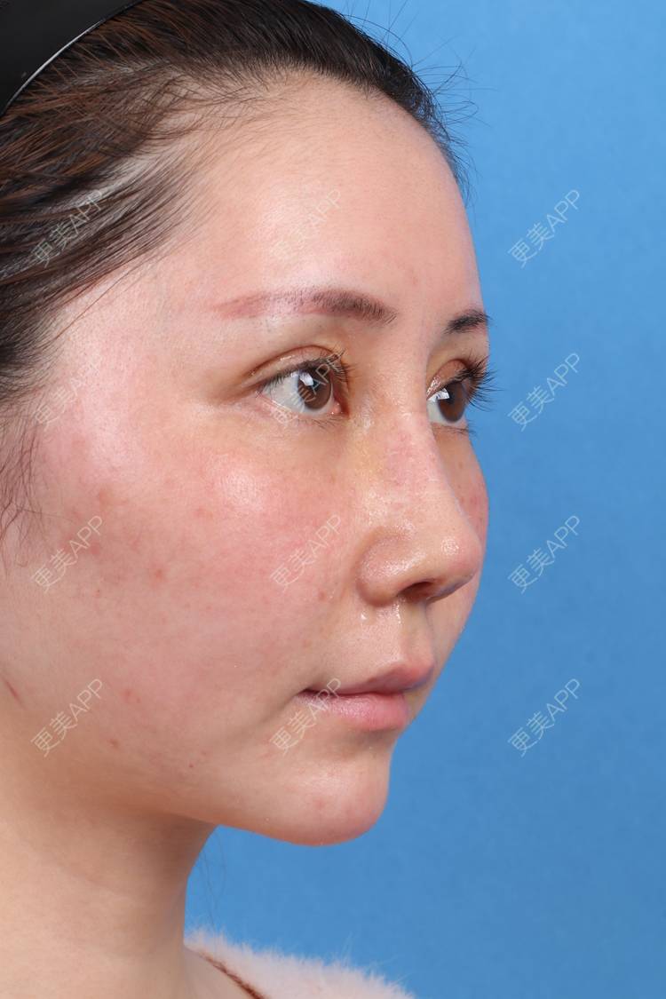 山根 耳软骨抬高鼻尖 鼻翼鼻头塑形/调整鼻部多项西安￥15800起【膨体