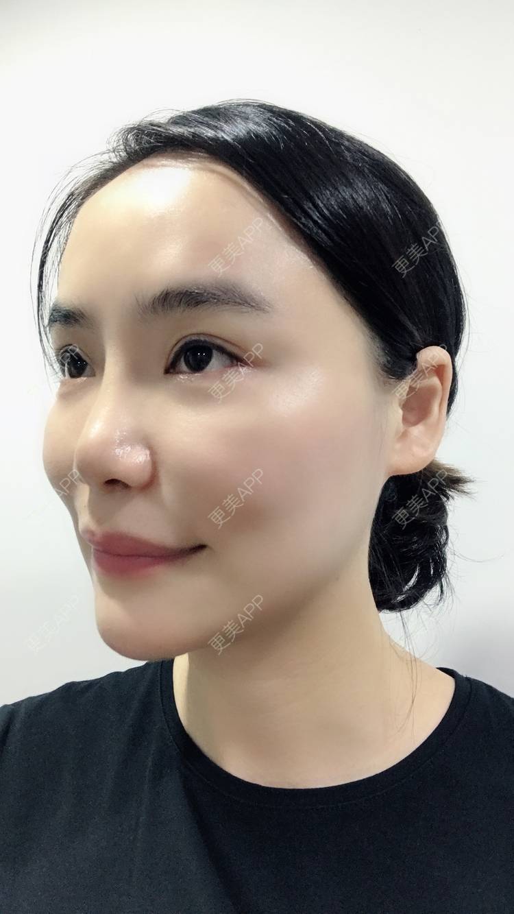 蜜桃乌兰的玻尿酸苹果肌日记