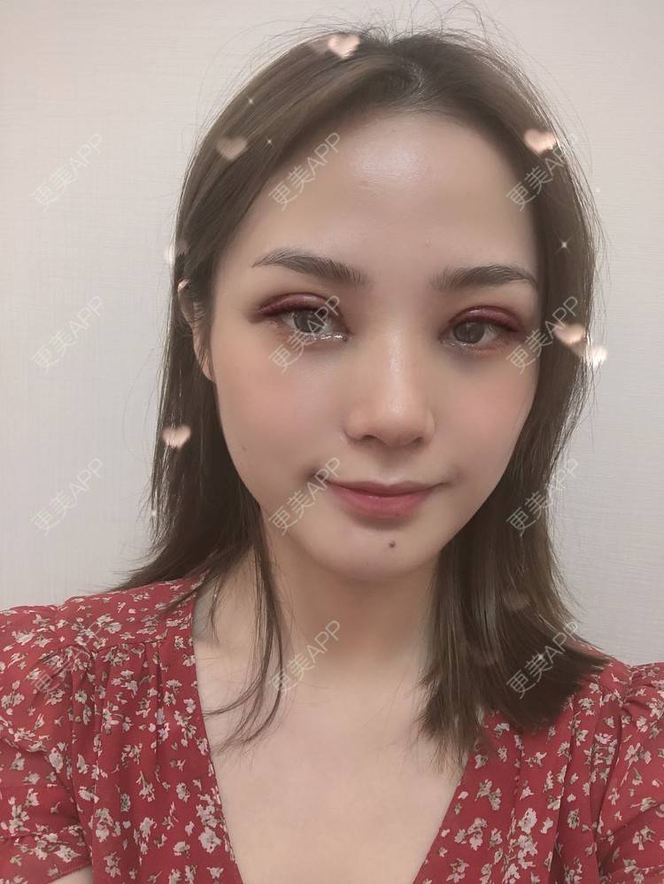 长腿鲁班的全切双眼皮日记