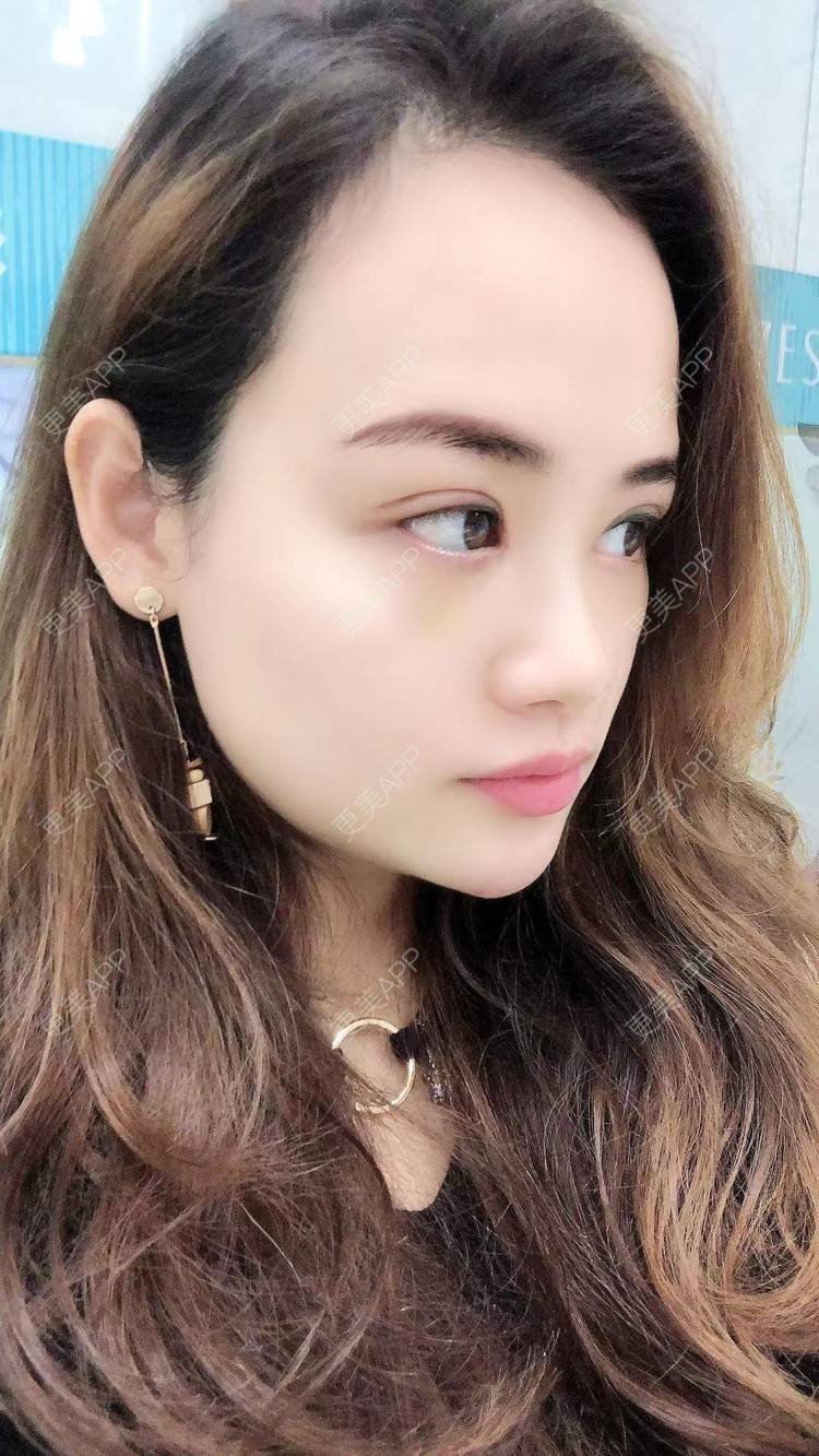 肉松饼干的全切双眼皮日记