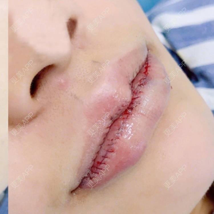 更美用户gi8dg6c0am的厚唇改薄术日记