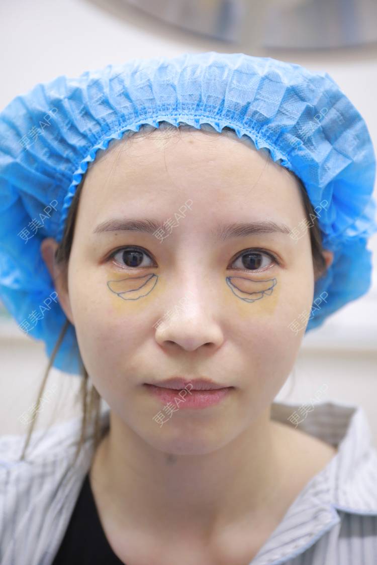 我是胡漂亮的内切去眼袋日记