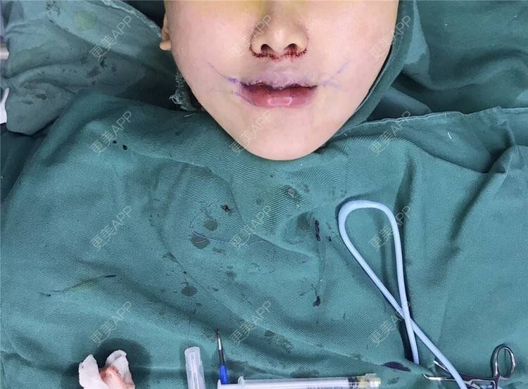 更美用户midzbvqbpz的微笑唇手术日记