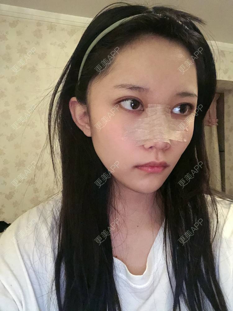 更美 - 更美用户J5NjYRZs4Y的硅胶隆鼻经验 | 硅胶隆鼻