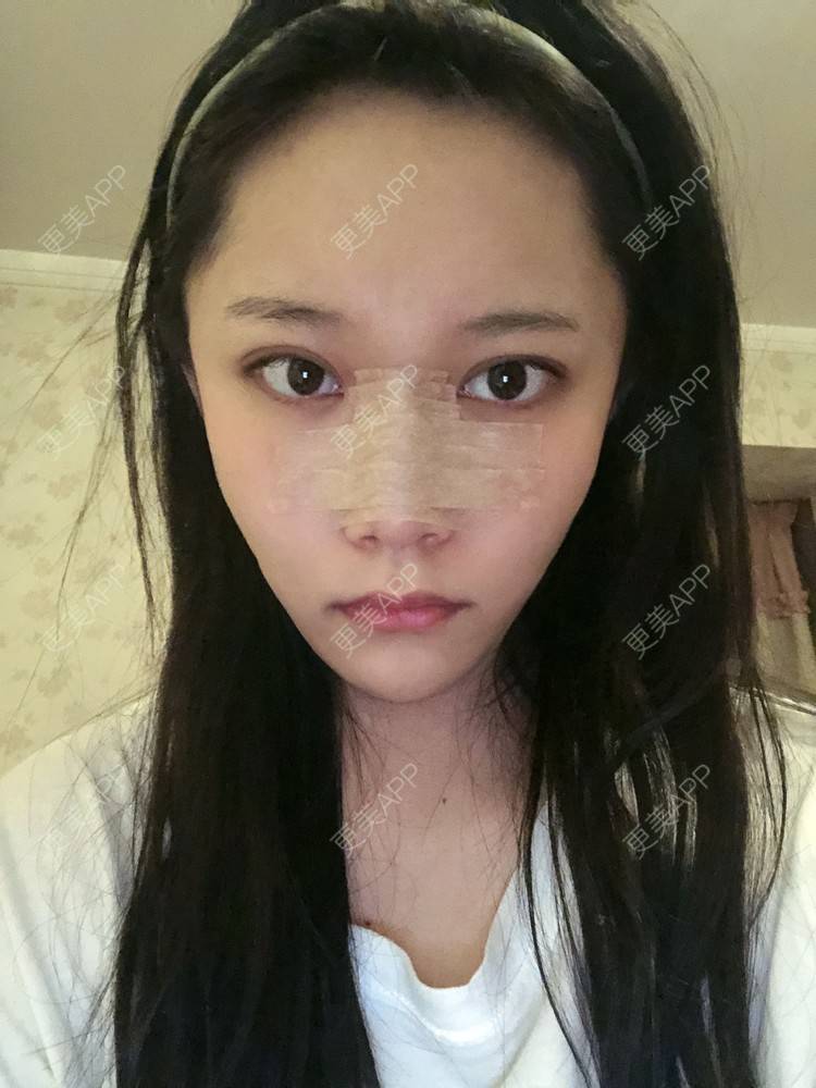 更美 - 更美用户J5NjYRZs4Y的硅胶隆鼻经验 | 硅胶隆鼻
