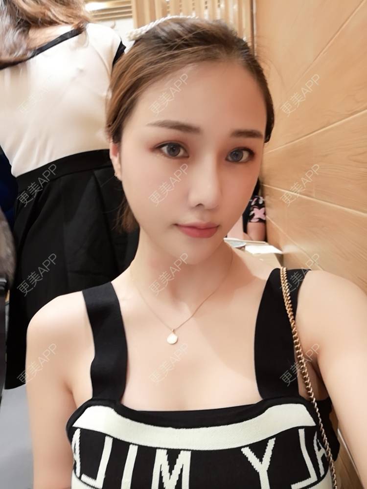 更美用户ys3gesnmab的假体隆胸日记