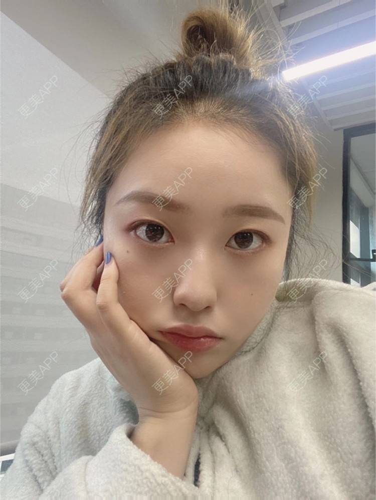 更美 - 努力变美123123的除皱瘦脸经验 | 除皱瘦脸 | 苏州