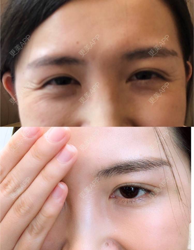 更美用户dxnzui3aum的注射改善鼻背纹日记