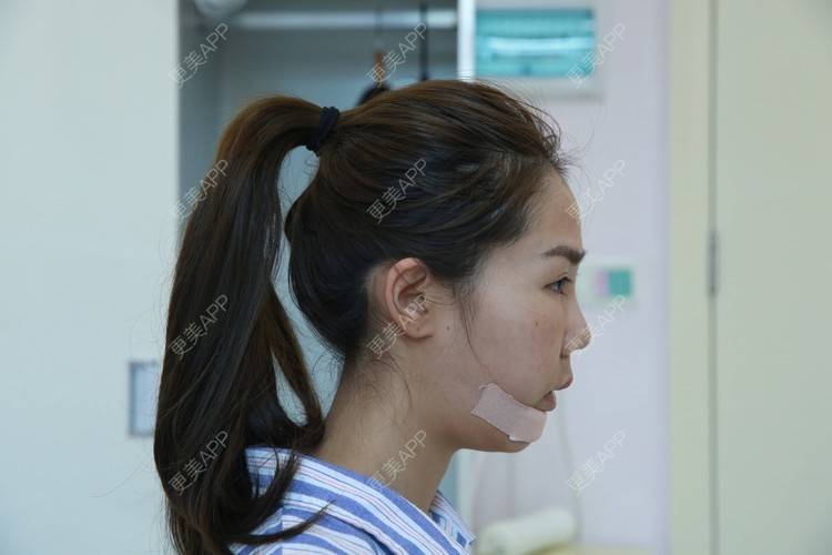 更美 - 更美用户zeqekzaxnn的凸嘴矫正日记 | 凸嘴矫正 | 正颌手术