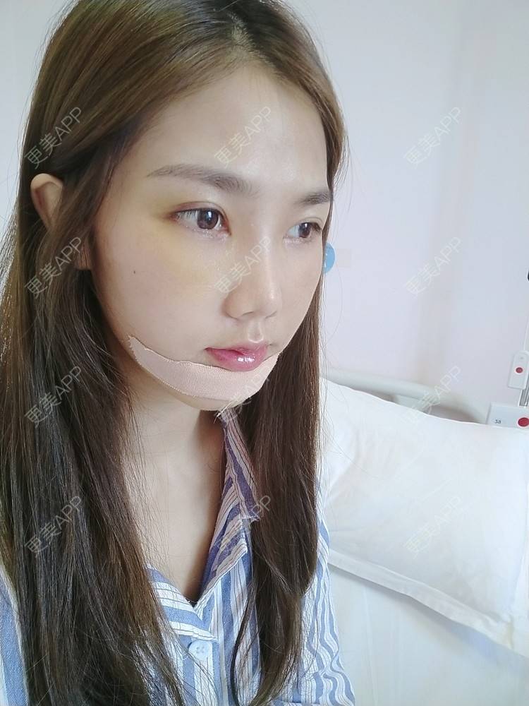 筱可爱得的凸嘴矫正日记