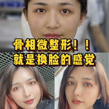 丰面颊前后效果对比 丰面颊前后对比图 恢复过程图 更美app官网