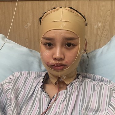 更美用户j6bmm7stdi的下颌角切除术日记