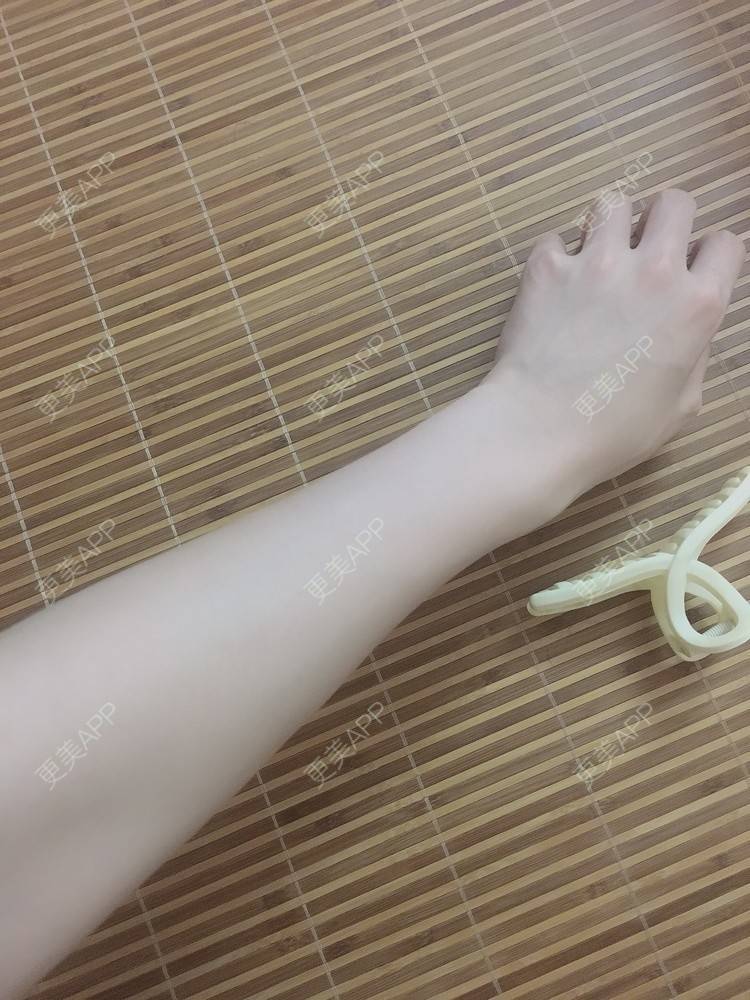 更美用户1icgeqmtow的手臂脱毛日记