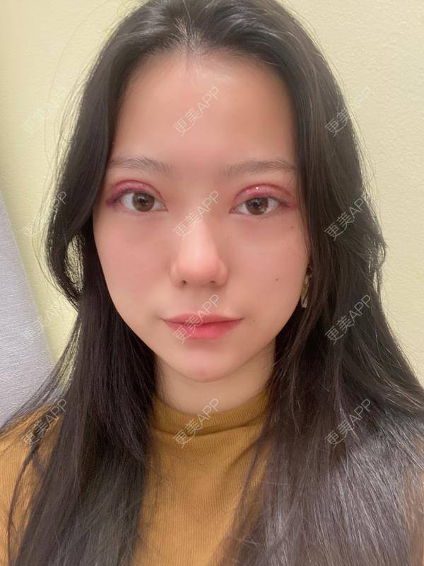 全切双眼皮效果图_更美用户b2j6no7myr全切双眼皮效果图_术后138天