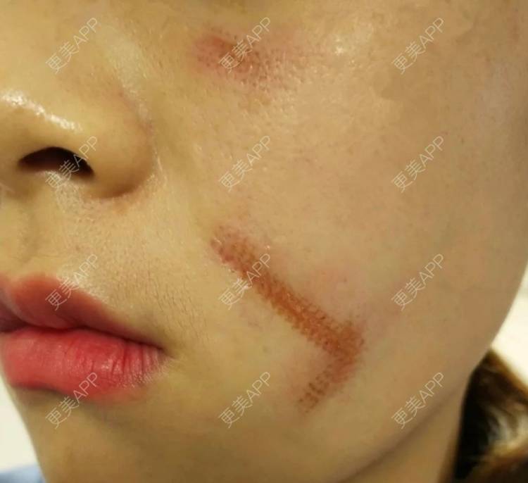 更美用户aozd7ssynq的激光淡疤日记