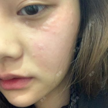 velvey的皮秒激光日记