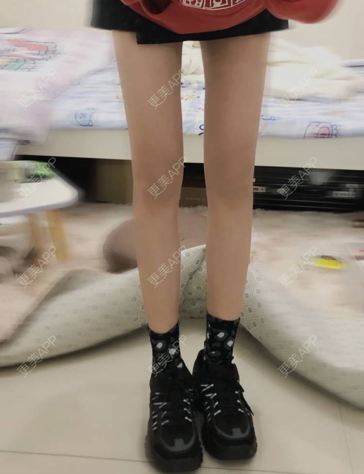 吸脂瘦大腿图片_更美用户pt92qhdydb吸脂瘦大腿图片_术后138天__更美