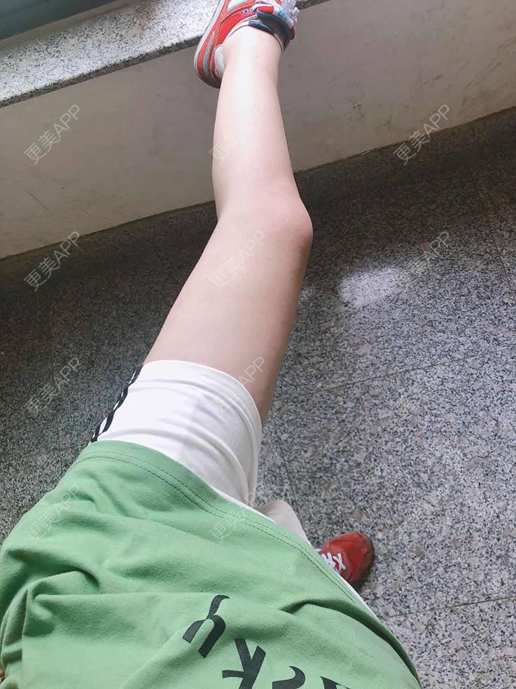 更美用户bjnvf9jxnl的吸脂瘦大腿日记