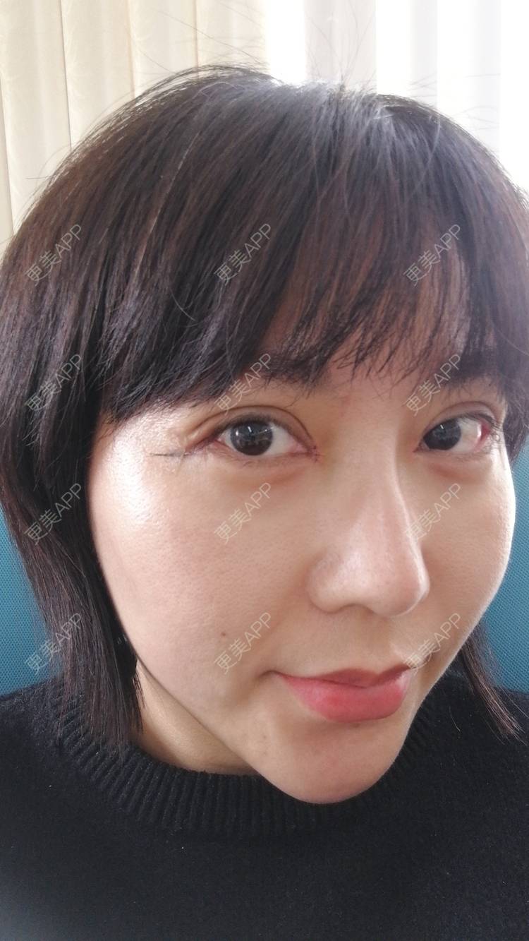 更美 - 更美用户qntmyjrrgv的开眼角日记 | 开眼角