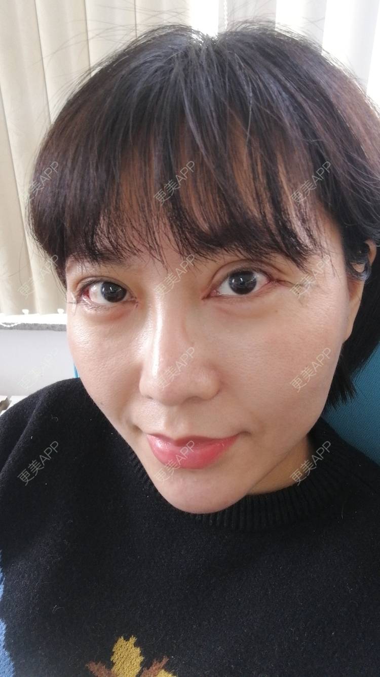 更美 - 更美用户qntmyjrrgv的开眼角日记 | 开眼角